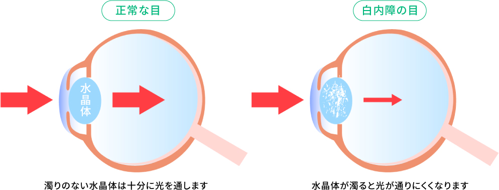 白内障手術